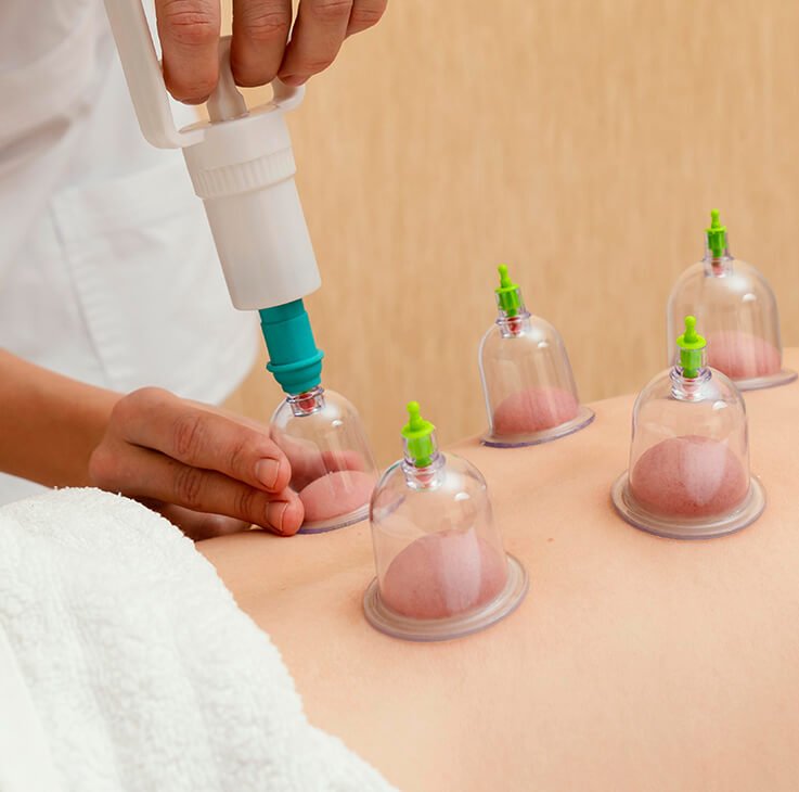Cupping Therapy